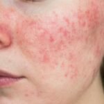 Ivermectin 1% Cream (Ivrea): How It Works for Rosacea and Skin Inflammation