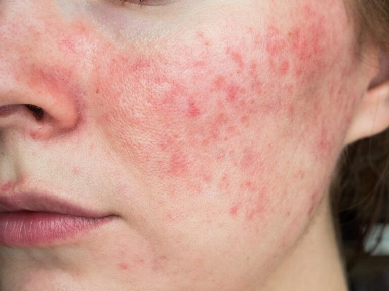 Ivermectin 1% Cream (Ivrea): How It Works for Rosacea and Skin Inflammation